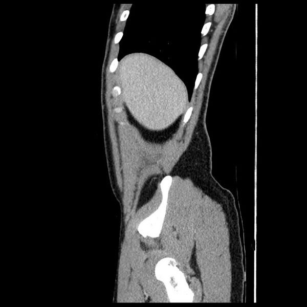 File:Co-existing acute appendicitis and epiploic appendagitis (Radiopaedia 61789-69911 B 11).jpg