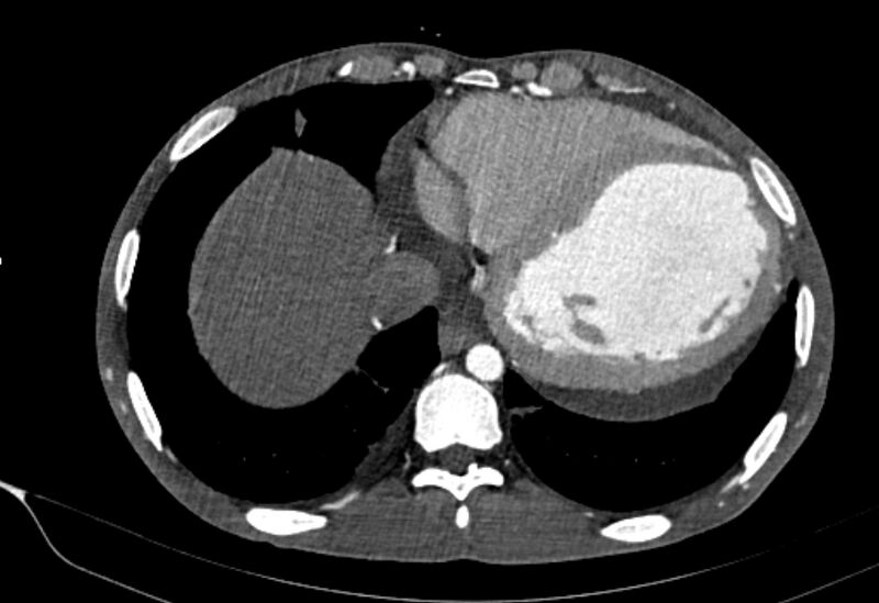 File:Coarctation of aorta with aortic valve stenosis (Radiopaedia 70463-80574 A 181).jpg