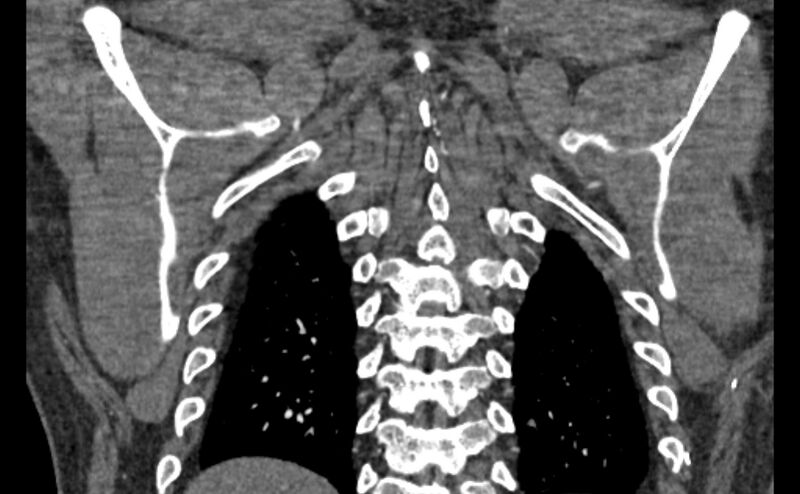 File:Coarctation of the aorta (Radiopaedia 53363-59343 C 60).jpg