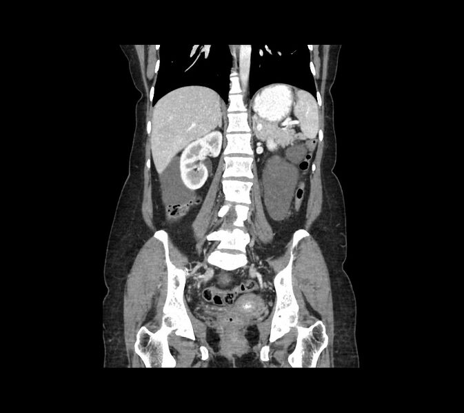 File:Cocoon abdomen with possible tubo-ovarian abscess (Radiopaedia 46235-50636 B 34).jpg