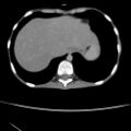 Colocolic fistula - Crohn disease (Radiopaedia 57063-63955 A 3).jpg