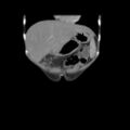 Colocolic fistula - Crohn disease (Radiopaedia 57063-63955 B 6).jpg