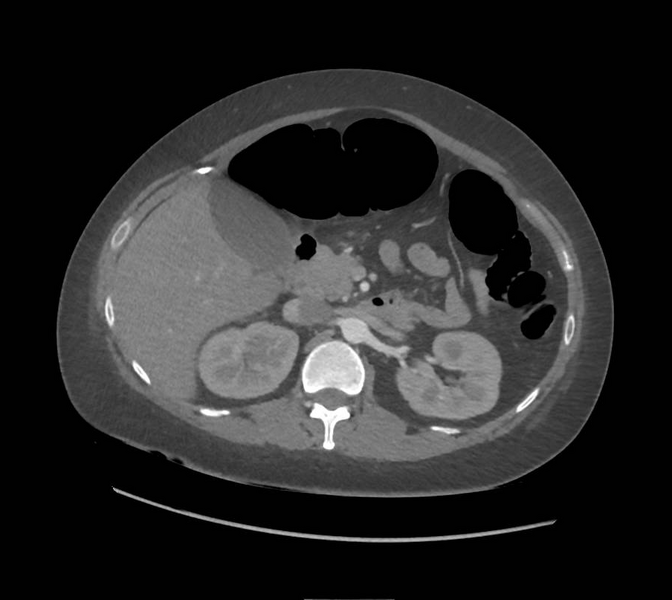 File:Colonic pseudo-obstruction (Radiopaedia 79752-92980 A 66).png