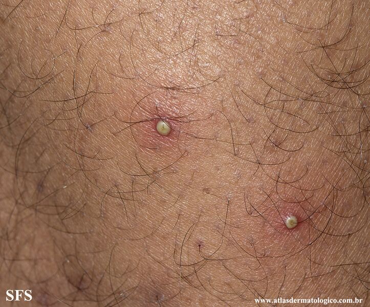 File:Folliculitis (Dermatology Atlas 15).jpg