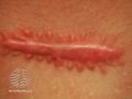 Keloid scar (DermNet NZ dermal-infiltrative-keloid22).jpg