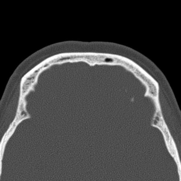 File:Nasolabial cyst (Radiopaedia 33987-35205 Axial bone window 44).jpg