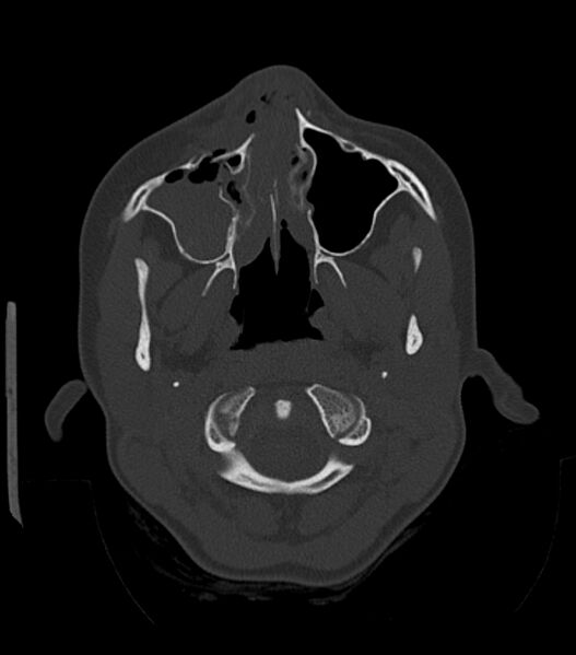 File:Nasoorbitoethmoid fracture (Radiopaedia 90044-107205 Axial bone window 61).jpg