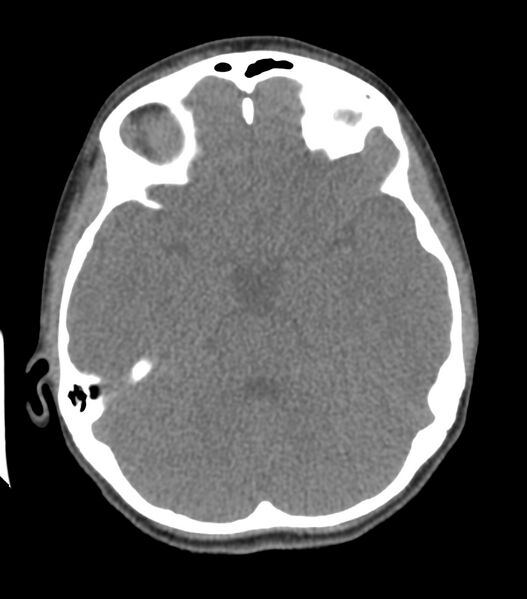 File:Nasoorbitoethmoid fracture (Radiopaedia 90044-107205 Axial non-contrast 182).jpg