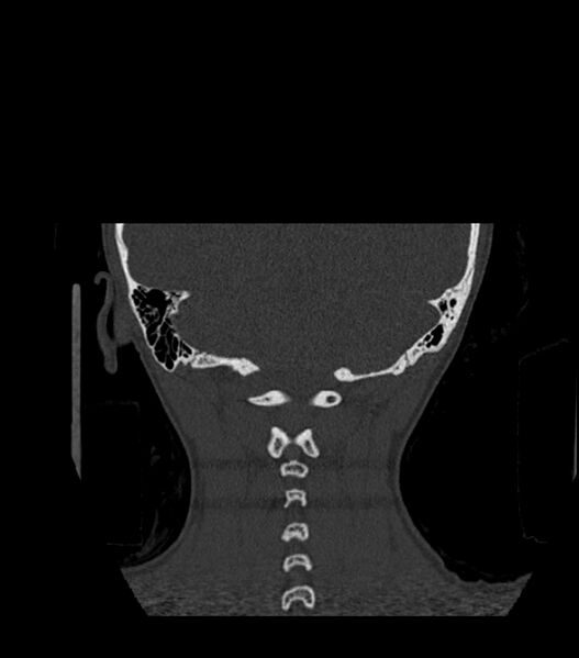 File:Nasoorbitoethmoid fracture (Radiopaedia 90044-107205 Coronal bone window 123).jpg