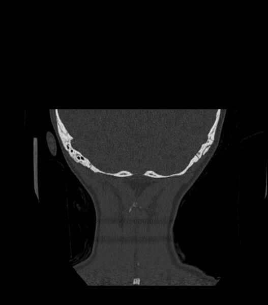 File:Nasoorbitoethmoid fracture (Radiopaedia 90044-107205 Coronal bone window 133).jpg