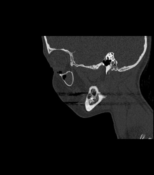 File:Nasoorbitoethmoid fracture (Radiopaedia 90044-107205 Sagittal bone window 107).jpg