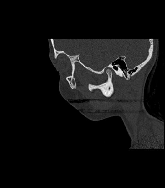 File:Nasoorbitoethmoid fracture (Radiopaedia 90044-107205 Sagittal bone window 114).jpg