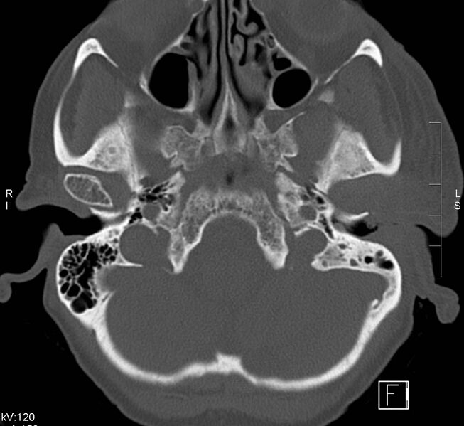 File:Necrotizing otitis externa (Radiopaedia 19938-19971 Axial bone window 1).jpg