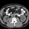 Necrotizing pancreatitis with acute necrotic collection (Radiopaedia 14470-14417 Axial non-contrast 23).jpg
