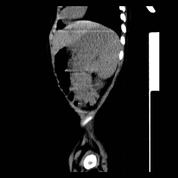 File:Neuroblastoma with skull metastases (Radiopaedia 30326-30960 B 38).jpg