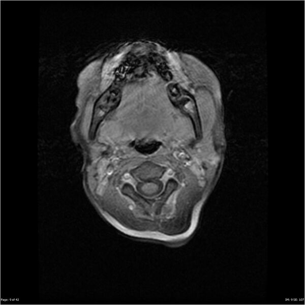 File:Neurofibromatosis type 1 (Radiopaedia 22541-22564 Axial T1 C+ fat sat 9).jpg