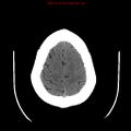 Neuroglial cyst (Radiopaedia 10713-11185 Axial non-contrast 6).jpg