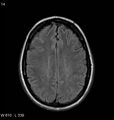 Neurosarcoidosis (Radiopaedia 10930-11351 Axial FLAIR 14).jpg
