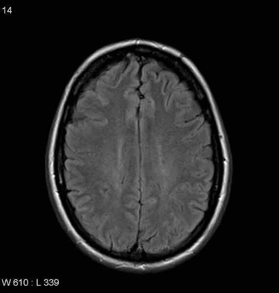 File:Neurosarcoidosis (Radiopaedia 10930-11351 Axial FLAIR 14).jpg