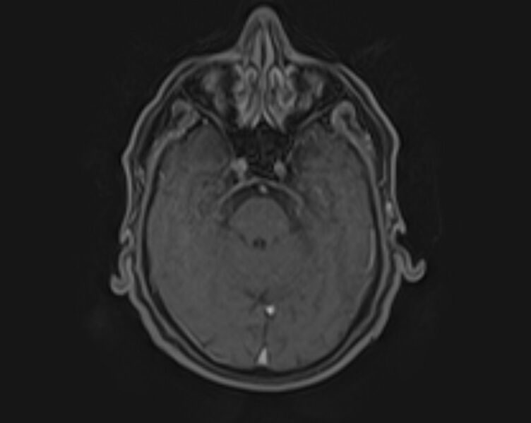 File:Non-Hodgkin lymphoma - parotid gland (Radiopaedia 71531-81890 E 50).jpg