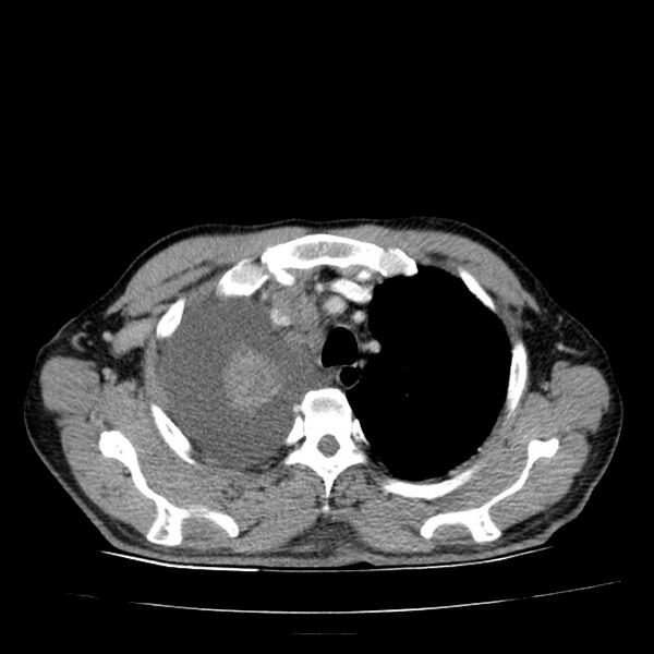 File:Non small-cell lung cancer (Radiopaedia 24467-24769 C+ delayed 15).jpg