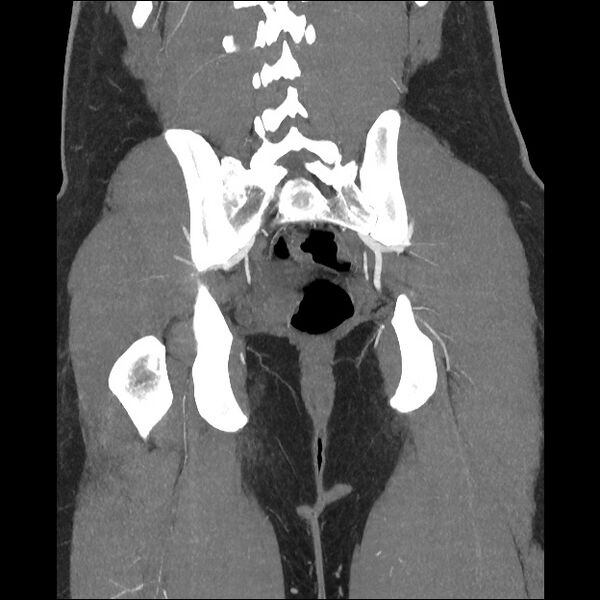 File:Normal CT angiogram of pelvis (Radiopaedia 45390-49430 B 34).jpg