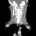 Normal CT of the neck (Radiopaedia 14575-14500 Coronal C+ 32).jpg