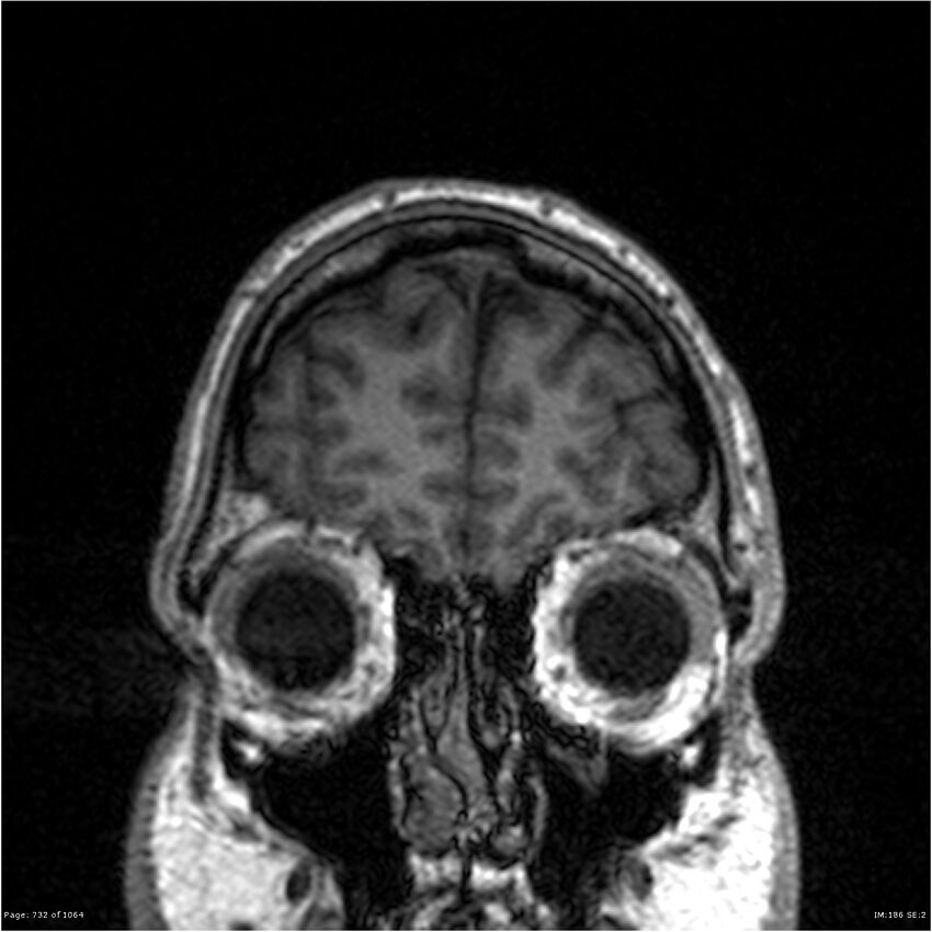 Normal brain MRI (non-focal epilepsy protocol) (Radiopaedia 38571-40700 Coronal T1 92).jpg