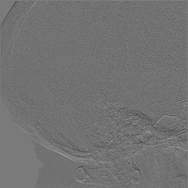 File:Normal cerebral angiogram (four vessel DSA) (Radiopaedia 41708-44649 R 5).png