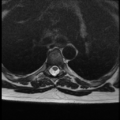 Normal cervical and thoracic spine MRI (Radiopaedia 35630-37156 H 30).png