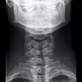 Normal cervical spine radiographs (Radiopaedia 32505-96697 B 1).jpeg