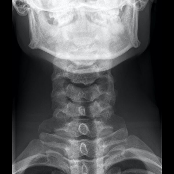 File:Normal cervical spine radiographs (Radiopaedia 32505-96697 B 1).jpeg