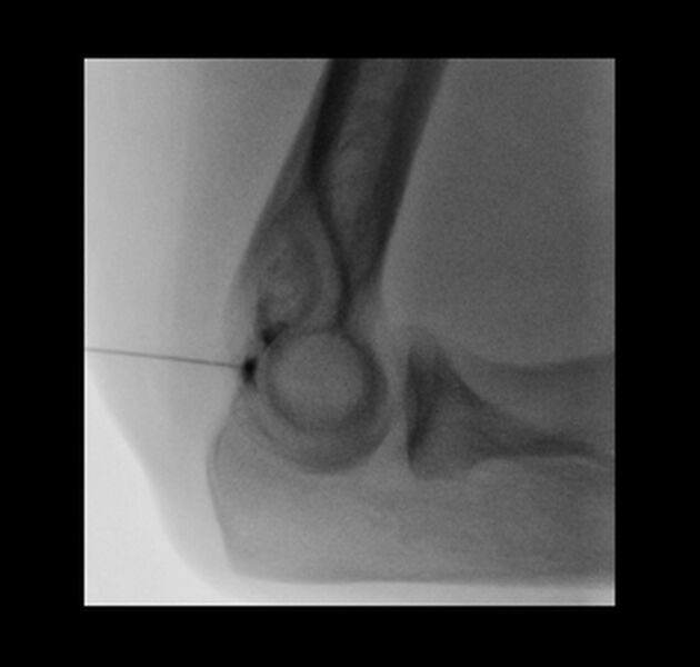 File:Normal elbow arthrograms (Radiopaedia 75550-86945 Lateral 11).jpg