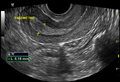 Normal pelvic ultrasound - transvaginal (Radiopaedia 31750-32684 F 1).png