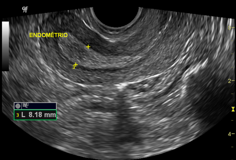 File:Normal pelvic ultrasound - transvaginal (Radiopaedia 31750-32684 F 1).png