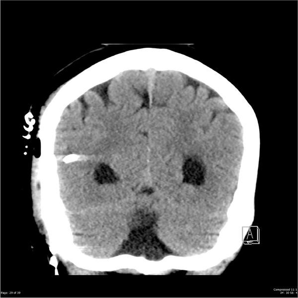 File:Normal pressure hydrocephalus (Radiopaedia 24415-24736 Coronal non-contrast 25).jpg