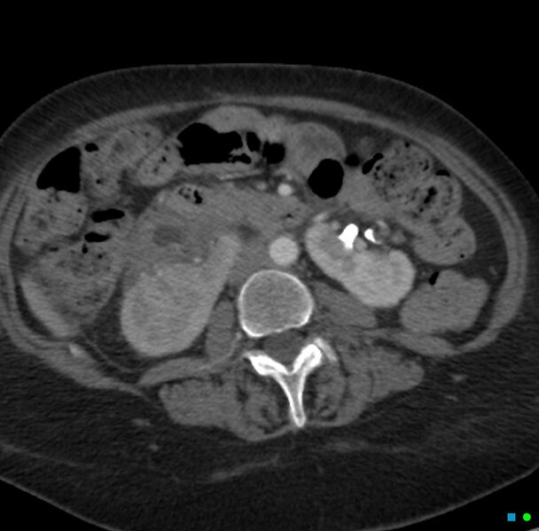 File:Obstructed infected horseshoe kidney (Radiopaedia 18116-17898 B 14).jpg