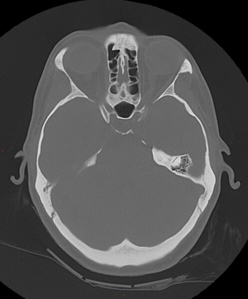 File:Occipital condyle fracture (Radiopaedia 61165-69056 Axial bone window 16).jpg