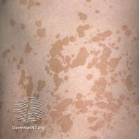 Pityriasis versicolor: dark well-defined marks