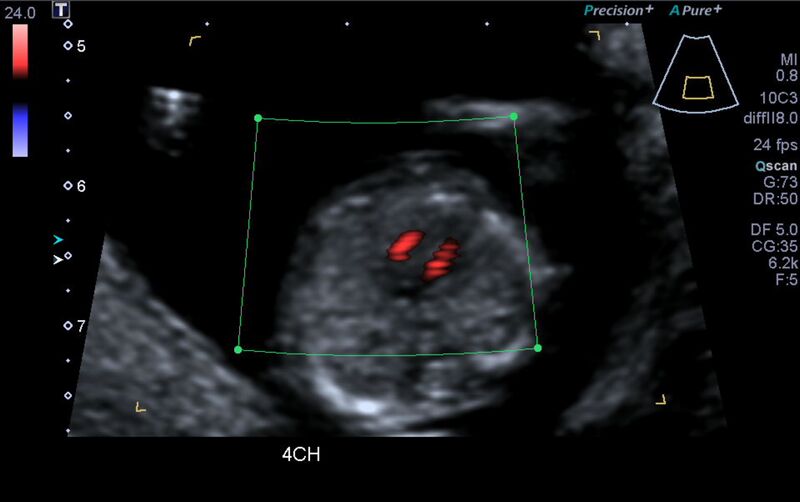 File:1st trimester nuchal-morphology ultrasound (Radiopaedia 44706-48477 Heart views cine with colour 50).jpg