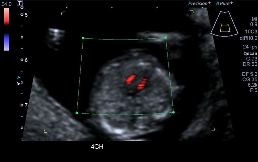 1st trimester nuchal-morphology ultrasound (Radiopaedia 44706-48477 Heart views cine with colour 50).jpg