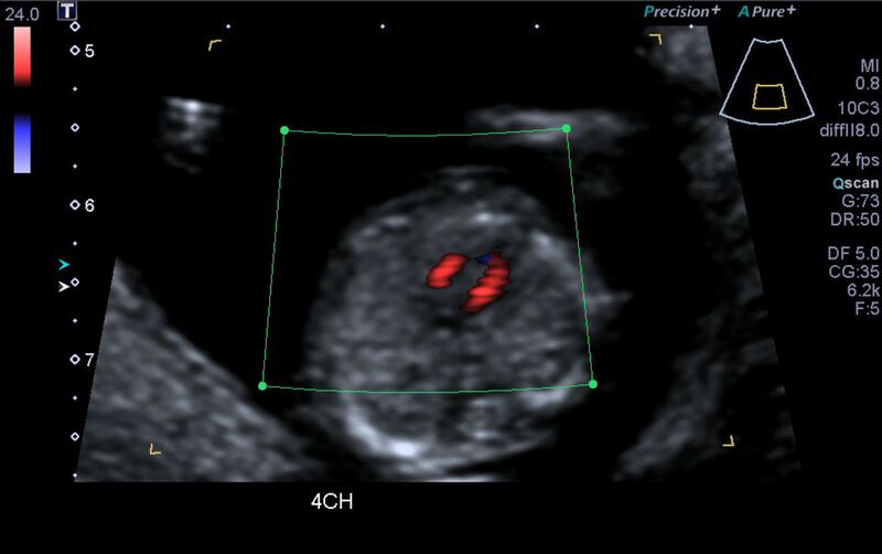 File:1st trimester nuchal-morphology ultrasound (Radiopaedia 44706-48477 Heart views cine with colour 51).jpg