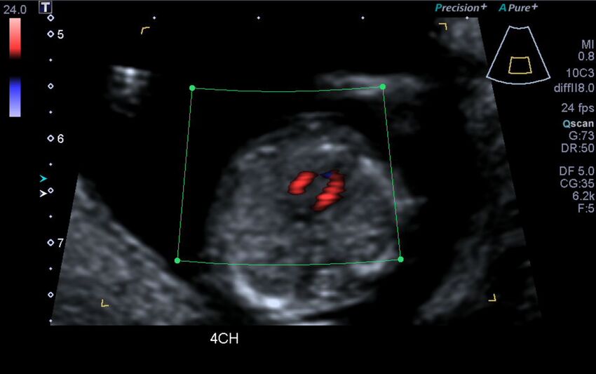 1st trimester nuchal-morphology ultrasound (Radiopaedia 44706-48477 Heart views cine with colour 51).jpg