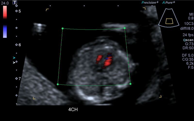File:1st trimester nuchal-morphology ultrasound (Radiopaedia 44706-48477 Heart views cine with colour 62).jpg