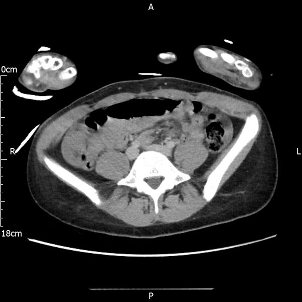 File:AAST grade IV kidney injury with CEUS follow-up (Radiopaedia 72353-82877 Axial C+ portal venous phase 48).jpg