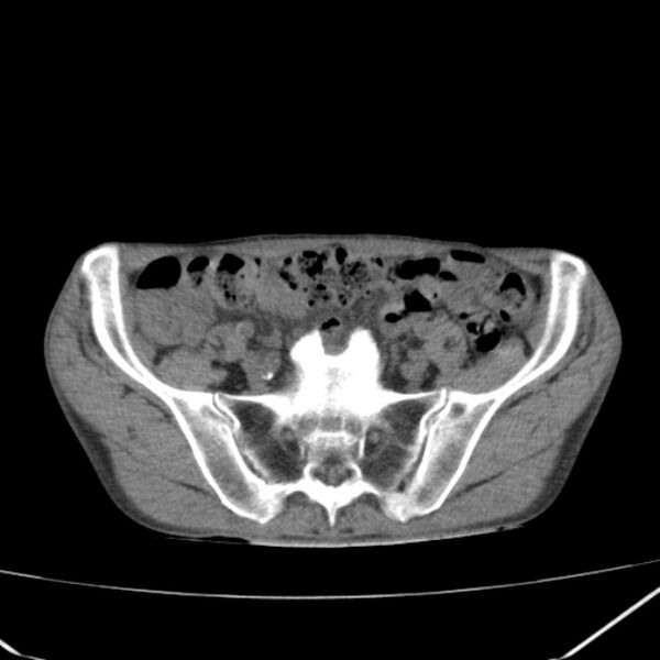 File:Abdominal aortic aneurysm (Radiopaedia 23703-23856 Axial non-contrast 44).jpg