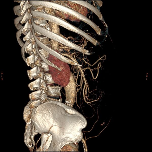 File:Abdominal aortic aneurysm (Radiopaedia 57318-64259 D 27).jpg