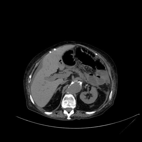 File:Abdominal aortic aneurysm - impending rupture (Radiopaedia 19233-19246 Axial non-contrast 41).jpg