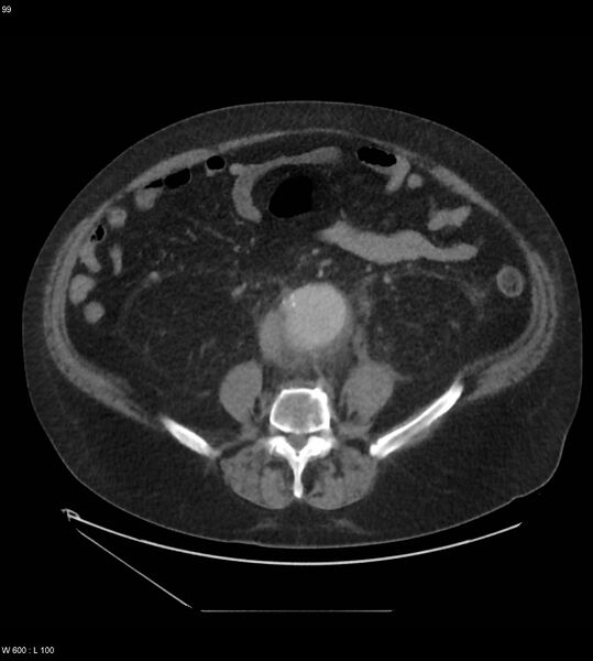 File:Abdominal aortic aneurysm with intramural hematoma then rupture (Radiopaedia 50278-55631 Axial C+ arterial phase 90).jpg