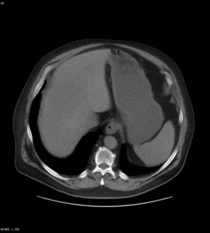 Abdominal aortic aneurysm with intramural hematoma then rupture (Radiopaedia 50278-55631 Axial non-contrast 46).jpg